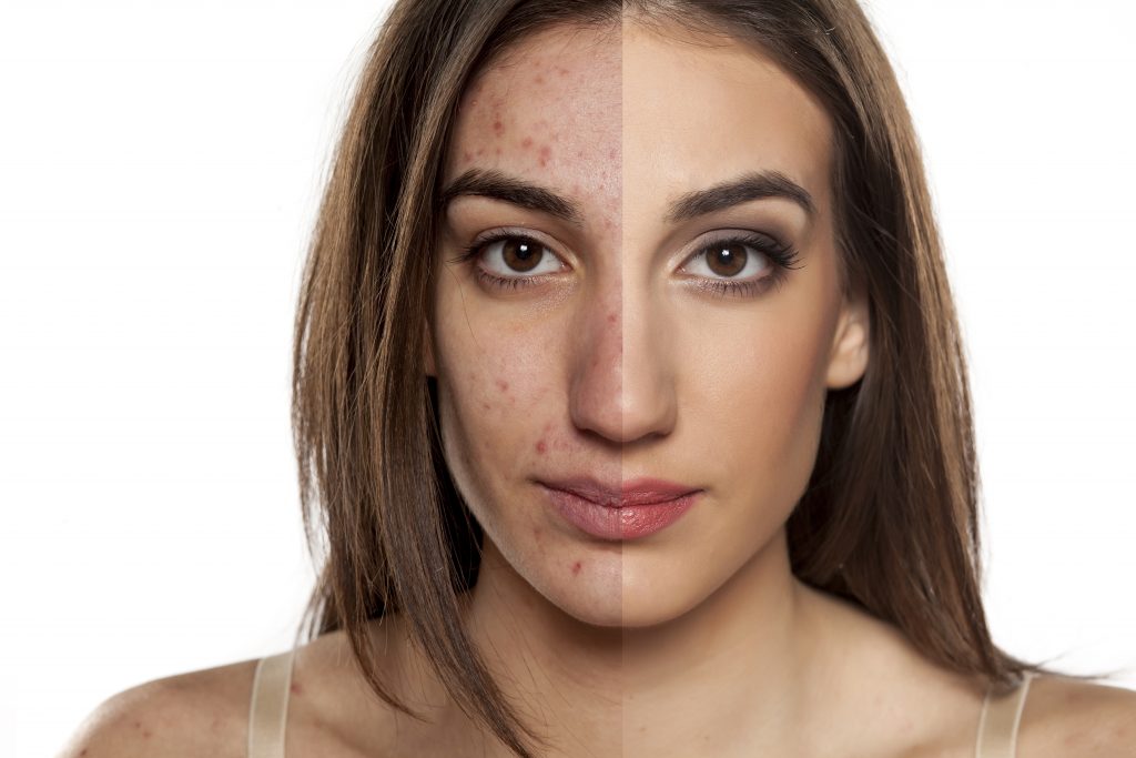 Acne: Before and after portrait with problematic acne