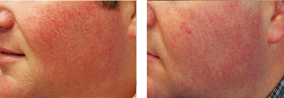 Before and after KTP laser procedure