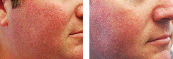 Before and after KTP laser procedure
