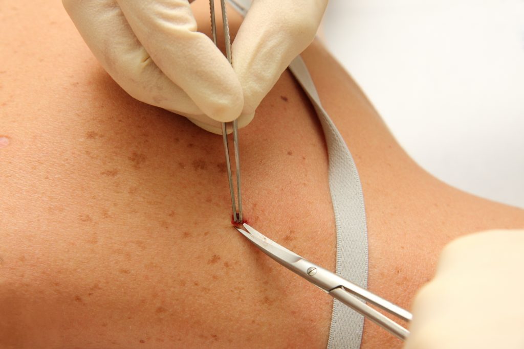 Doctor removing mole from a patient's shoulder.