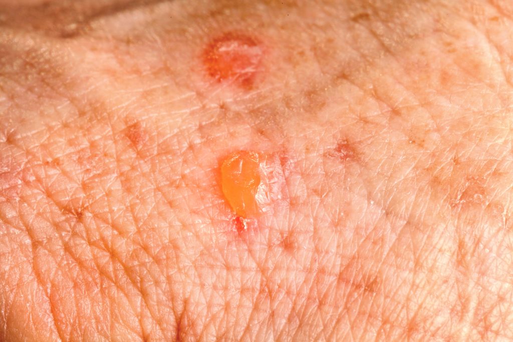 Actinic Keratosis two days after a freezing removal treatment