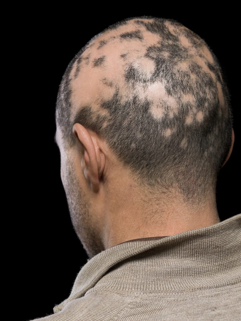 Alopecia areata: View of a man's head with Alopecia Areata