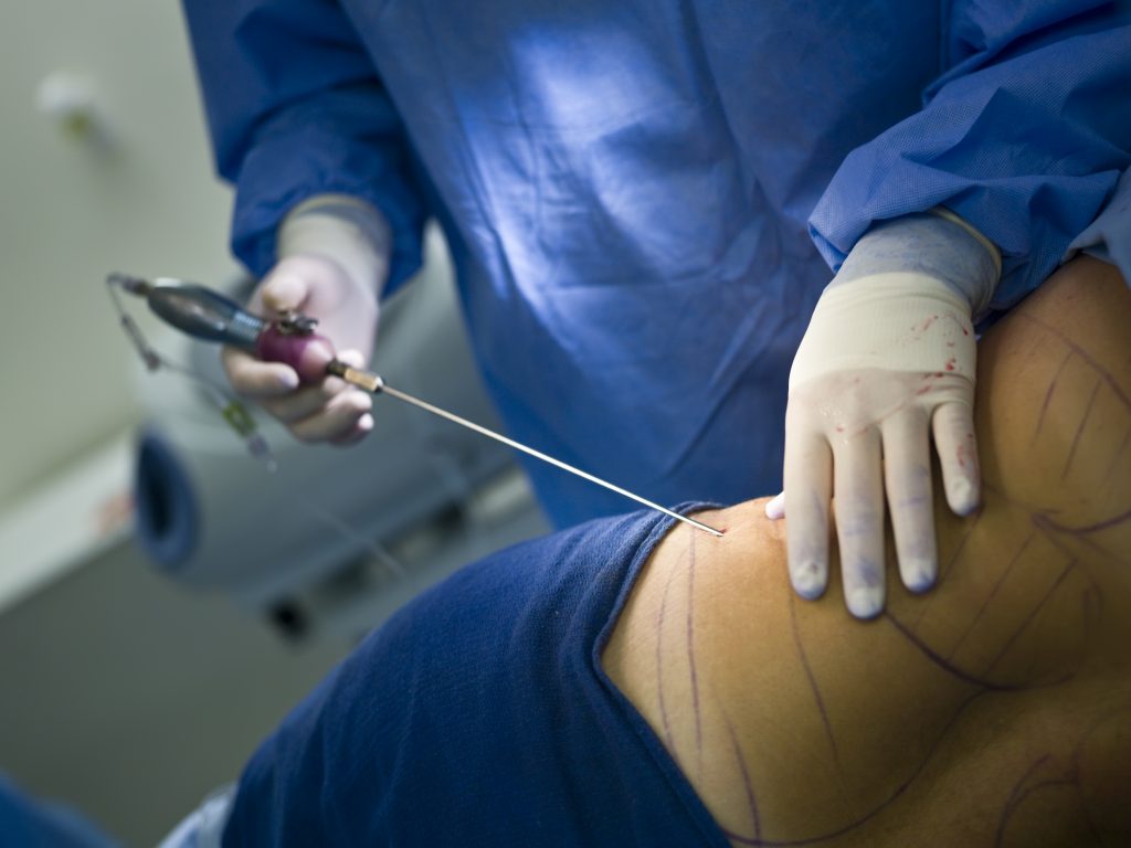 Surgeon performing liposuction on a patient.