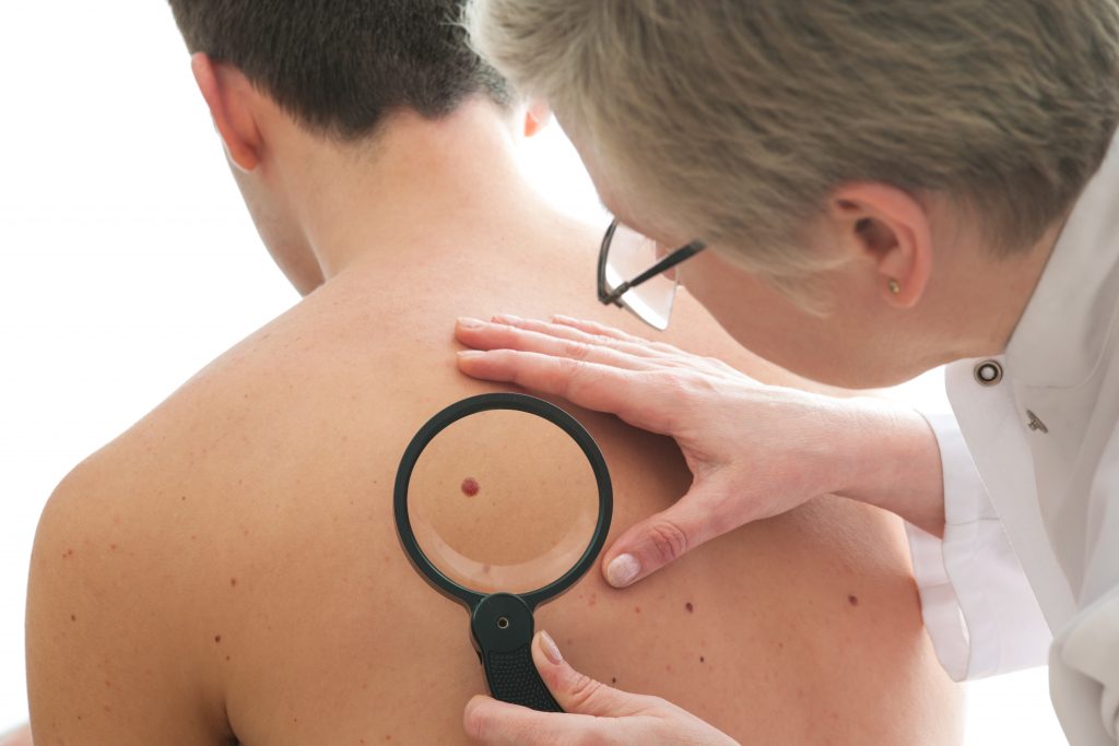 Annual Skin Examinations: Dermatologist examines a mole of male patient