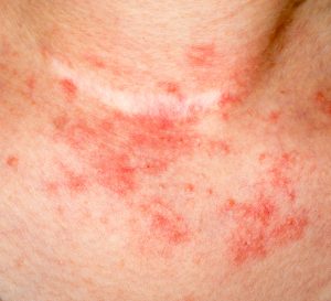 Eczema skin on neck