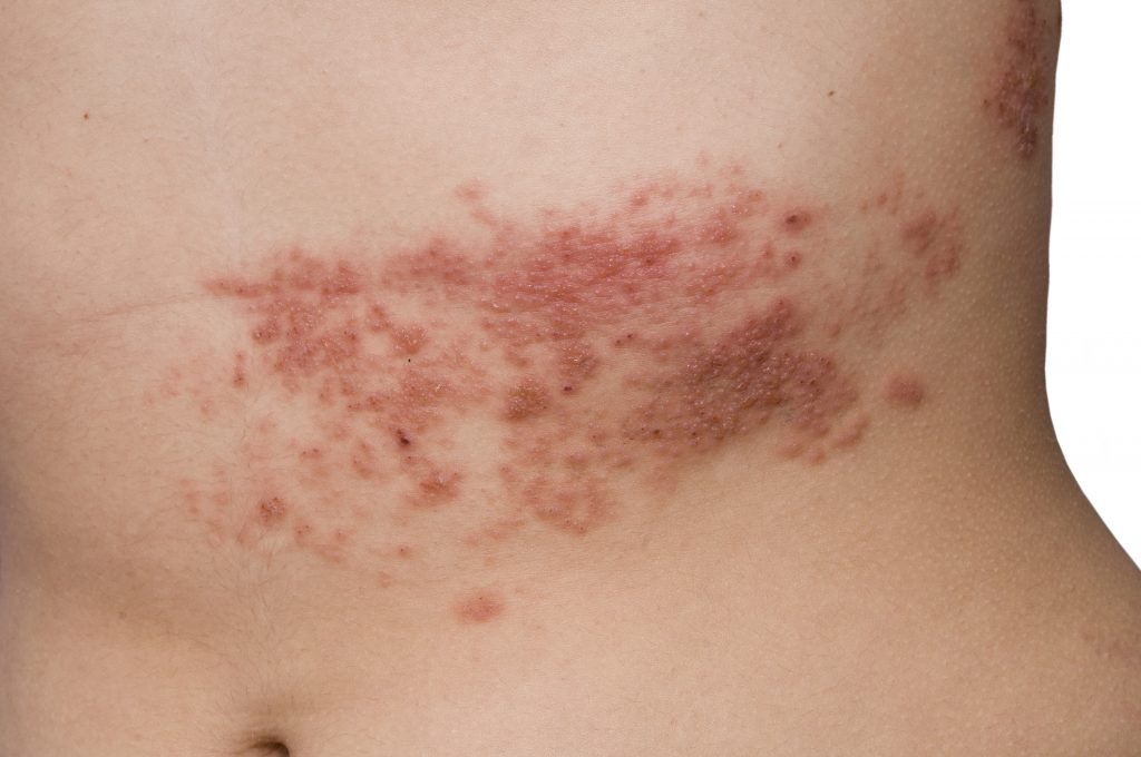 Shingles rash on abdomen.