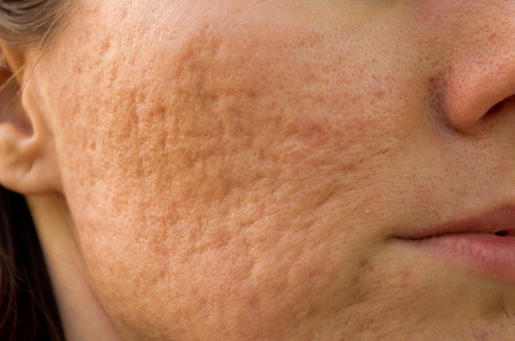 Scars left on the face from cystic acne.