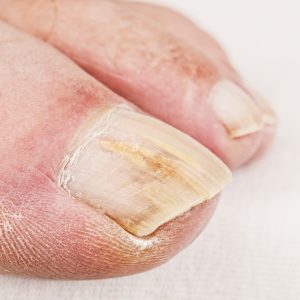 Close-up of a big toe infected with toenail fungus. 