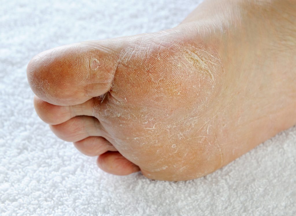 Athletes foot: itchy dry skin affected by athletes foot