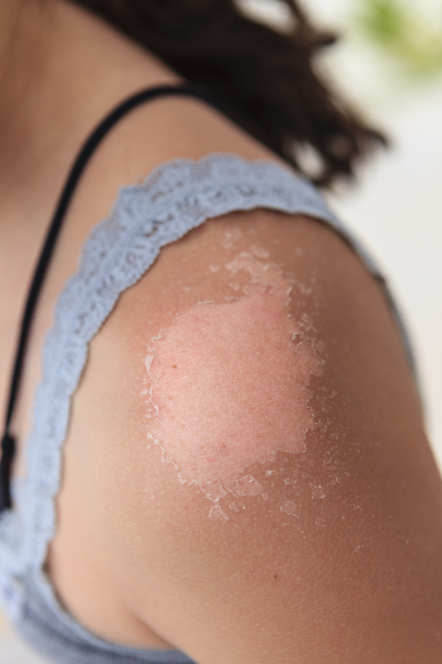 Woman with skin peeling from sunburn