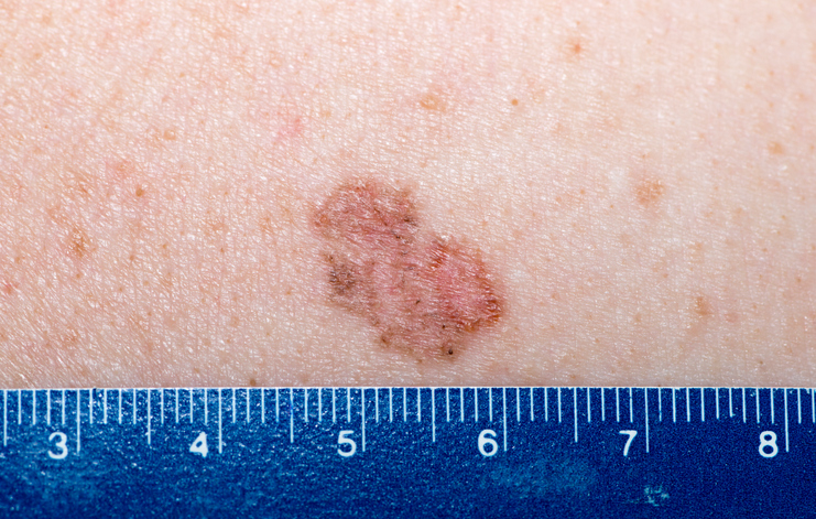 Basal cell carcinomas can have many appearances, such as this pigmented superficial type basal cell carcinoma.