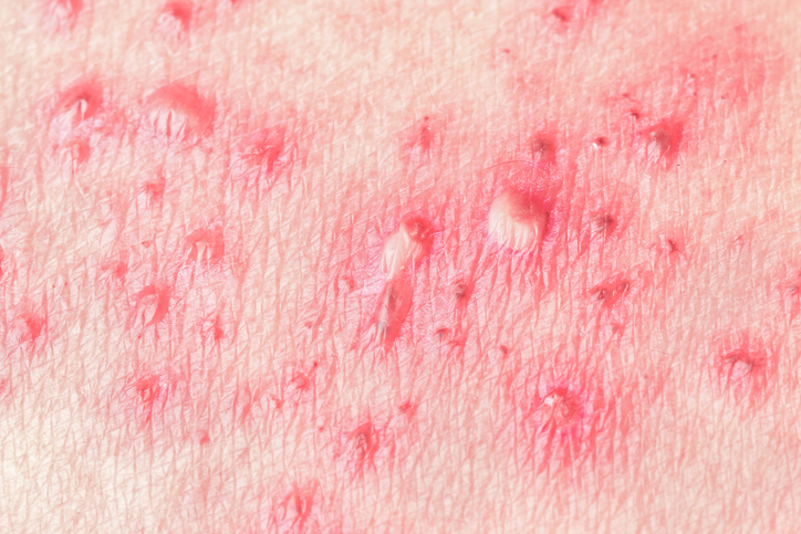 Detail of skin with hives outbreak.