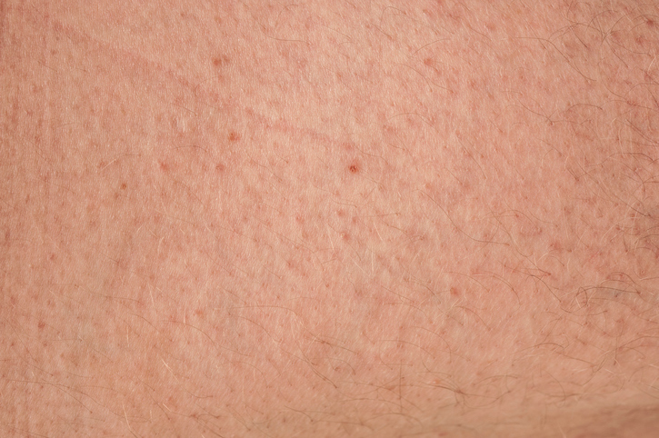 Keratosis pilaris (clogged pores and keratin overproduction) on the skin.
