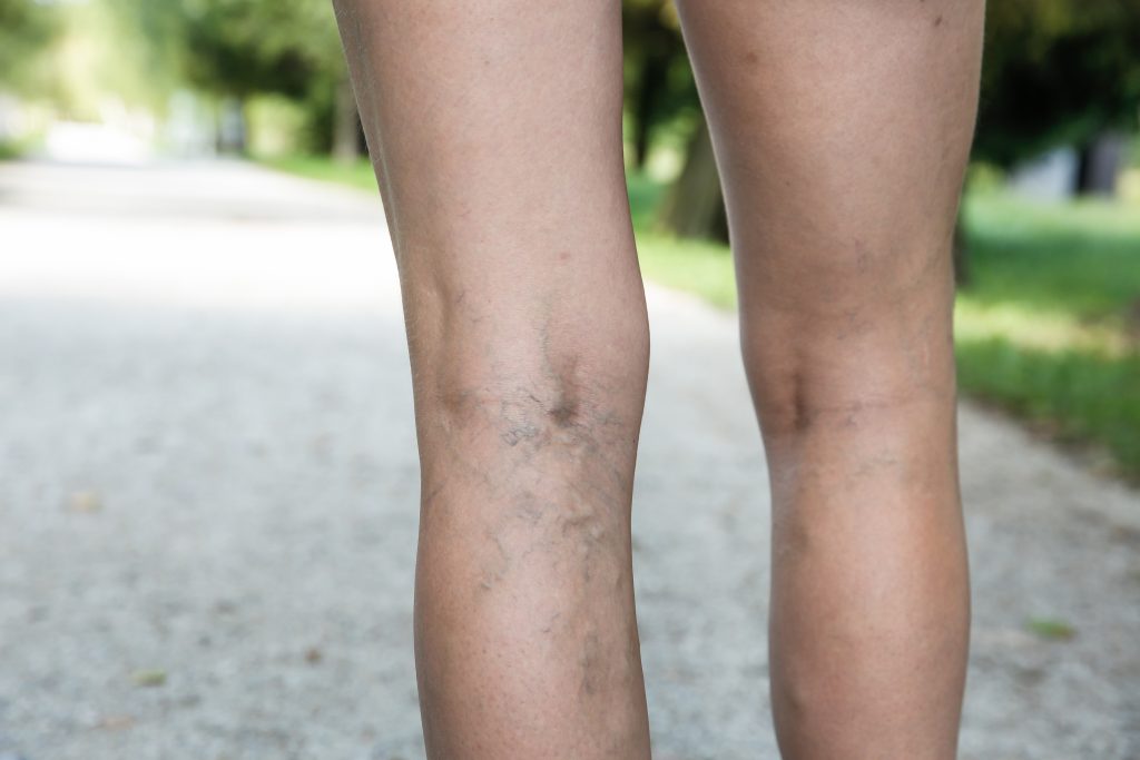 Varicose and spider veins on a woman's legs.