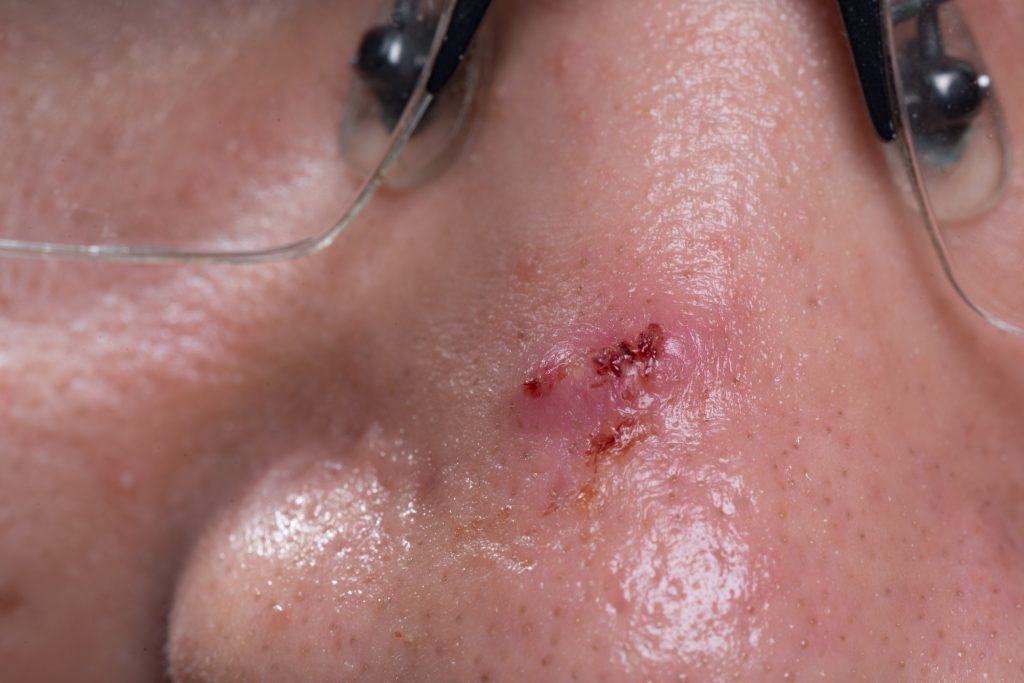 Basal cell carcinoma often affects the skin on or around the face