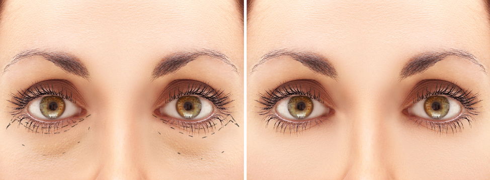 Blepharoplasty procedure before and after