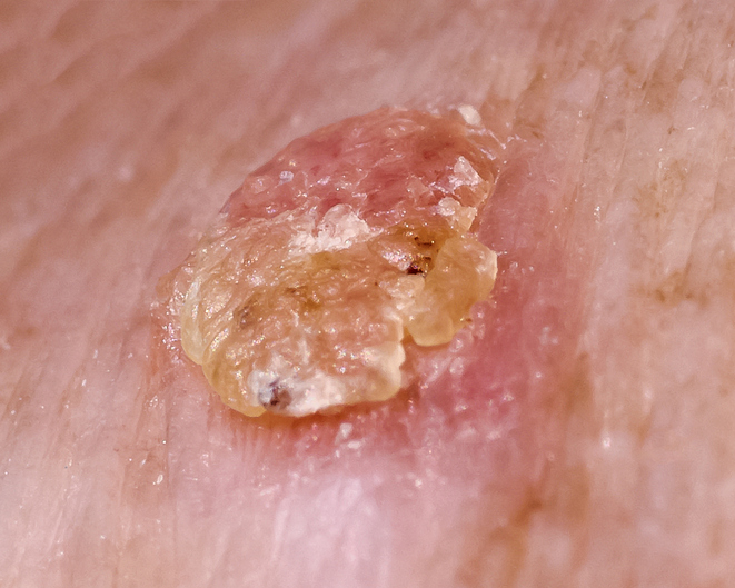 pre-cancerous actinic keratosis