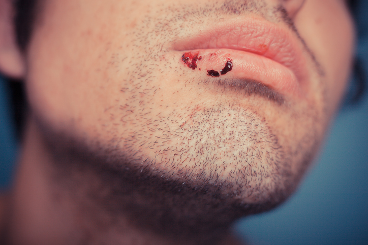 Man with cold sore before treatment