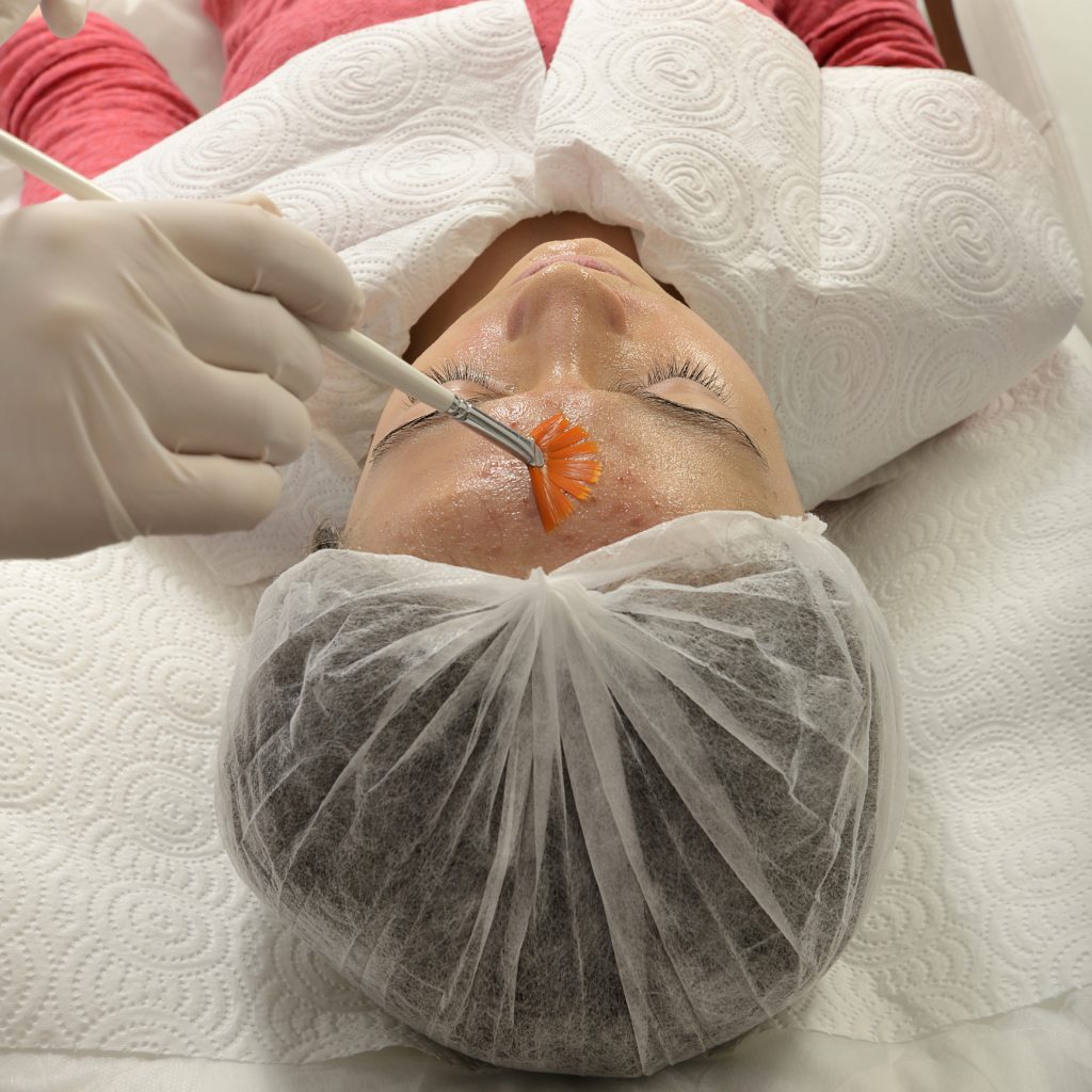 Chemical Peels are a relatively quick procedure.