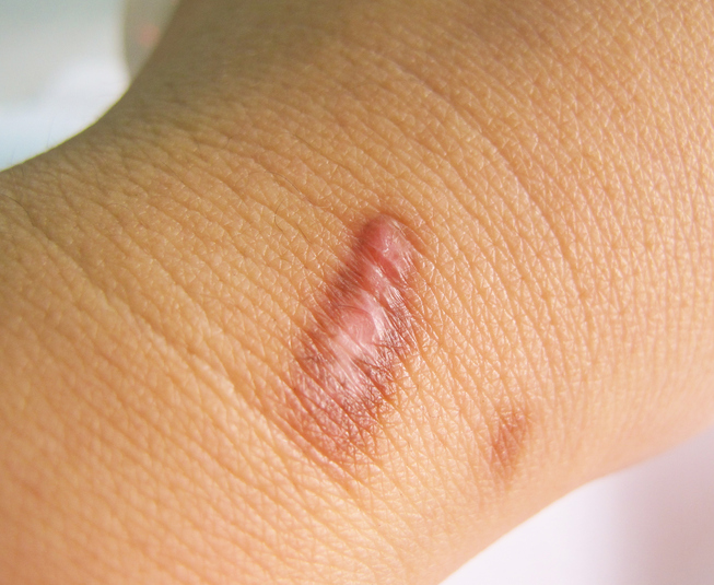 Keloid scars on a patient's wrist.