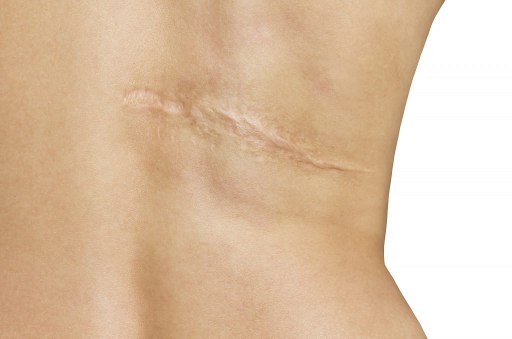 A scar on a woman's back.