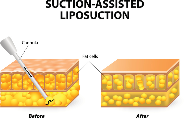 Liposuction diagram