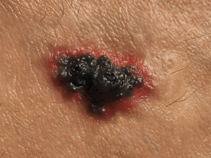 Melanoma skin cancer