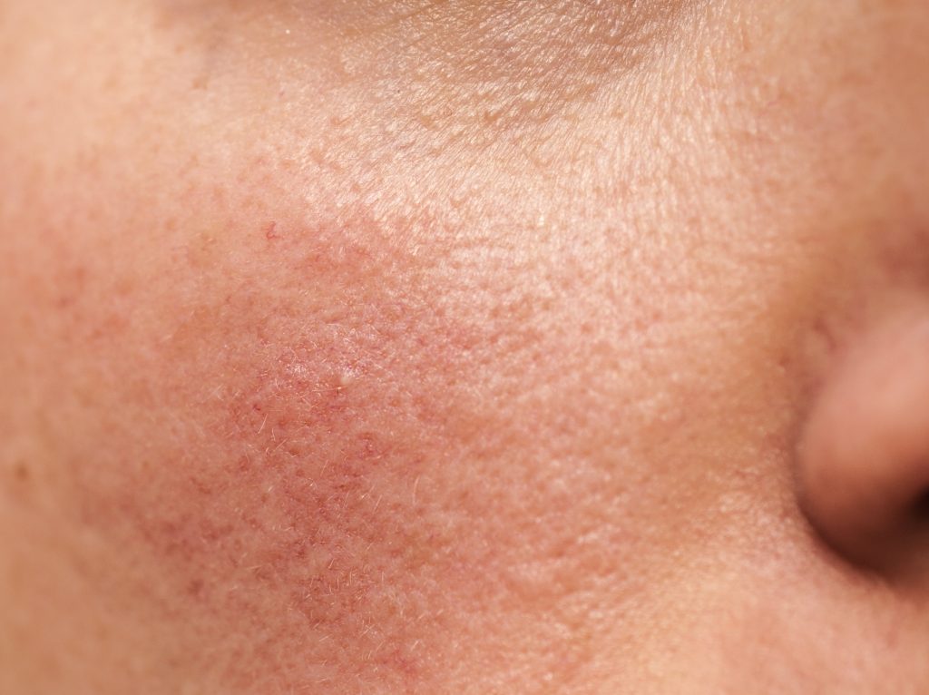 Rosacea on facial skin, treatable with laser rosacea therapy
