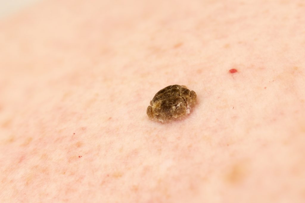 Seborrheic keratosis also known as seborrheic verruca or a senile wart.