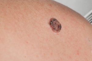 Squamous cell cancer can keratinize and blacken