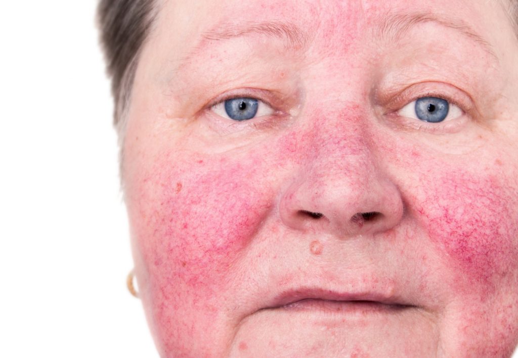 Rosacea Treatment on facial skin.