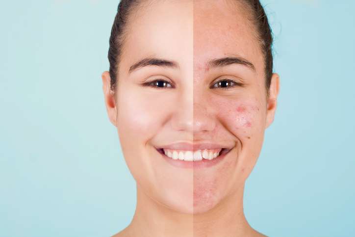 Skin before and after acne treatment.