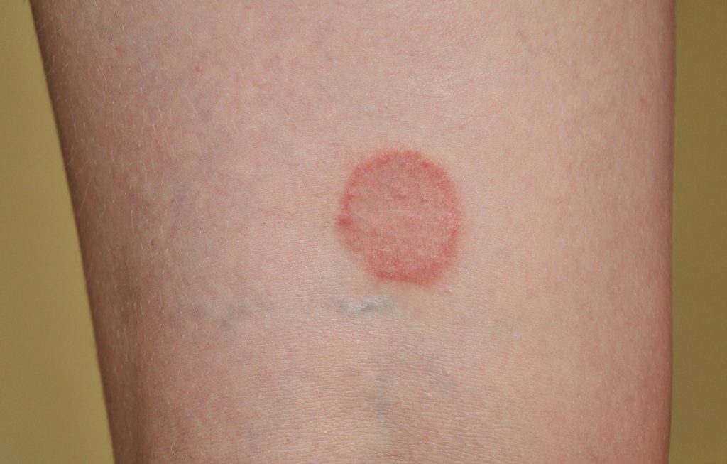 Ringworm on forearm.