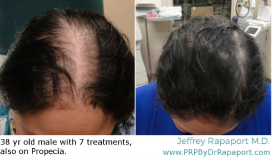 prp-hair-loss