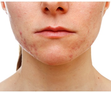 Acne often occurs in troublesome areas like the lower face and chin.
