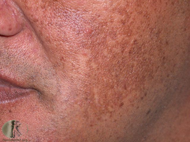 Melasma creates grown to gray-brown patches on the face. 