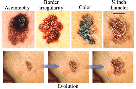 types of melanoma