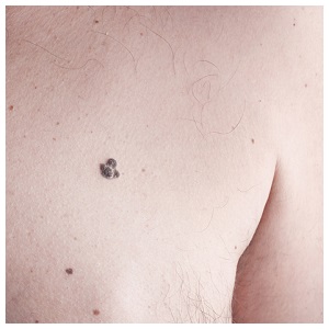 melanoma