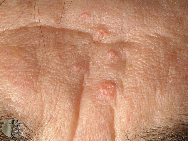 Sebaceous hyperplasia causes small, pimple-like growths on the face