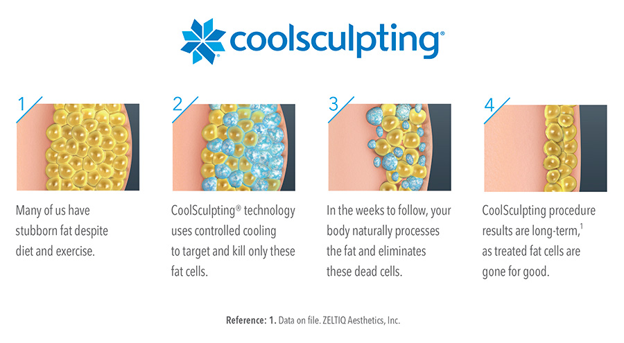 What is CoolSculpting? U.S. Dermatology Partners Side Effects Risks Benefits