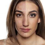 Acne: Before and after portrait - FInding best acne treatment for you