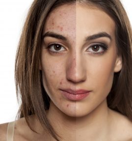 Acne: Before and after portrait - FInding best acne treatment for you