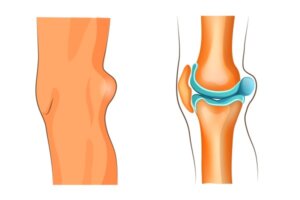Bakers cysts – These cysts develop around the knee usually due to injury, surgery, or arthritis. Unlike other cysts that don’t cause pain or other issues, bakers cysts can significantly impede range of motion without treatment.