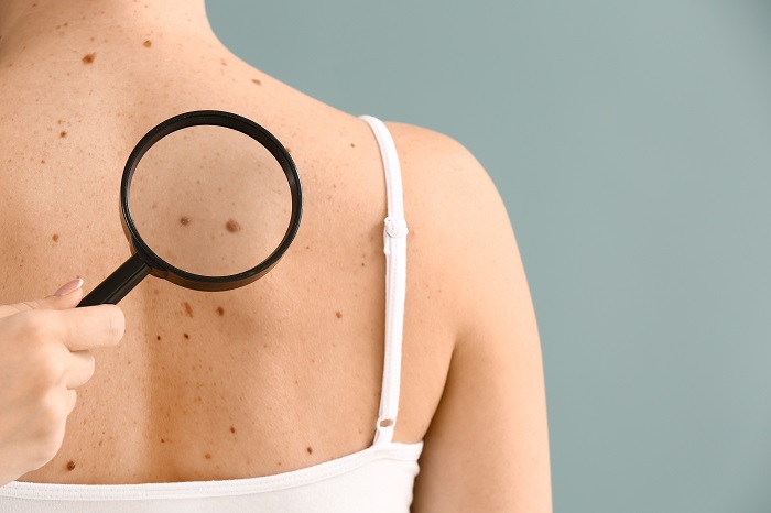 Early Detection is Key in the Fight Against Skin Cancer - A program designed to increase accessibility of skin cancer screenings, allowing suspicious lesions to be evaluated within 72 hours.