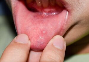Mucous cysts – These cysts form around the mouth. Typically, mucous cysts develop when the salivary glands are damaged or clogged due to biting the cheek or lip, receiving a piercing, being injured in a sports accident, practicing ineffective oral hygiene, or any other situation where the salivary gland may be damaged.