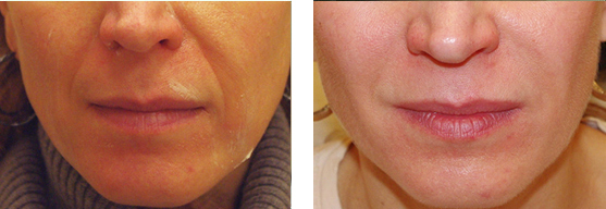 Before and After Juvederm Treatment