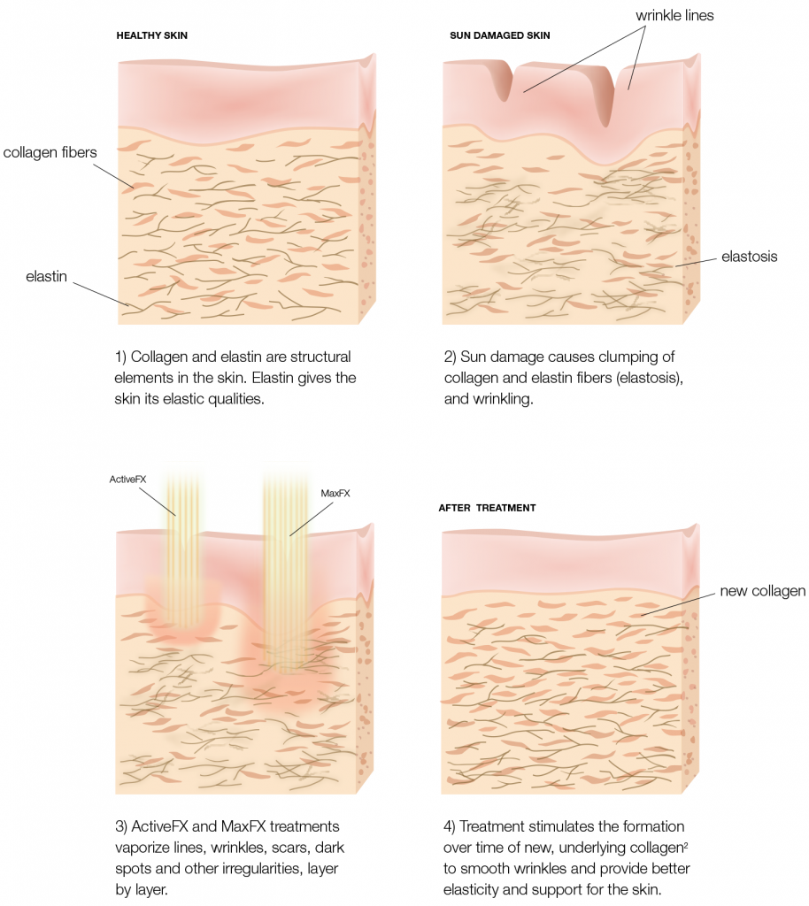 Co2 laser treatment effect