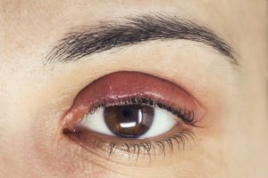 Chalazia – These cysts form when the oil glands around the eyes are blocked. This blockage can lead to the formation of cysts on the upper or lower eyelids. Unlike other cysts that are typically painless, this benign growth can actually cause a lot of issues, including pain, swelling, and impeded vision.
