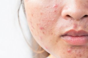 Chemical Peels for Acne Scars