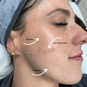 Dermaplaning is an effective exfoliation procedure that makes skin look younger, healthier & vibrant; treats acne scarring, mature skin or an uneven skin tone.